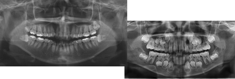 矯正の検査って何をするの? 何がわかるの? ~矯正治療前の精密検査
