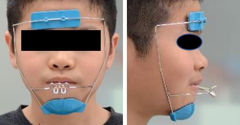 上顎前方牽引装置（MPA）とは？]受け口の場合に使用する矯正装置 | なんぽ歯科クリニック新百合ヶ丘